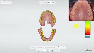 Bite Scan test TRIOS intraoral scanner [upl. by Cohleen]