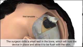 Cochlear Implant [upl. by Olnee]