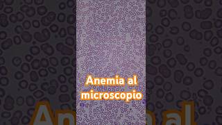 Así se ve la anemia al microscopio hematología anemia laboratorioclinico [upl. by Aicargatla]