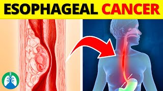 Top 10 Early Warning Signs of Esophageal Cancer  NEVER Ignore THIS [upl. by Cave]