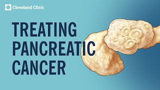 Treating Pancreatic Cancer [upl. by Eralc]