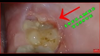 Wisdom tooth with inflamed tissue at the back pericoronitis [upl. by Ellocin]