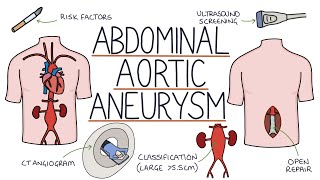 Understanding Abdominal Aortic Aneurysms [upl. by Akiram]