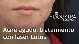 Acné agudo tratamiento con láser Lotus 15039 [upl. by Scoter]