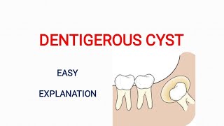 Dentigerous Cyst  Lecture  Odontogenic cysts  Oral Pathology  Easy explanation [upl. by Olram]