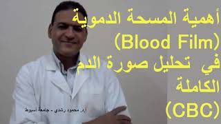 أهمية المسحة الدموية في تحليل صورة الدم الكاملة Importance of blood smear in CBC [upl. by Misha]