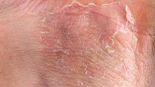 Eczema GRAPHIC Fast Outbreak Treatment Options  Eczema Dermatitis Rash Treatment 2015 [upl. by Horatio449]