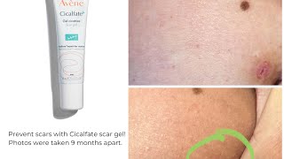 Avène Cicalfate Scar gel How to prevent scars treat them amp real before amp after photos included [upl. by Jeramie]