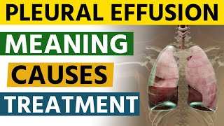 Pleural Effusion  Meaning  Causes  Treatment  लंग्स में पानी का इलाज [upl. by Gasper]