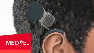 How Do Cochlear Implants Work The SYNCHRONY Cochlear Implant  MEDEL [upl. by Ellennahs]