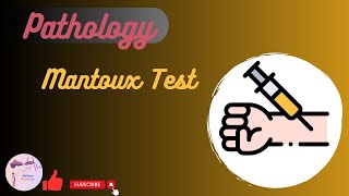 Mantoux Test [upl. by Sone]