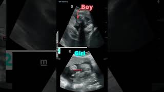 Baby Boy Or Baby Girl Ultrasound pregnancy baby babygirl babyboy girl boy babywithyou [upl. by O'Reilly708]