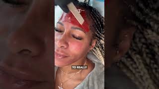 Fabulous Shereé Whitfield gets her second MelanX Chemical Peel 💥 The Real Housewives of Atlanta st [upl. by Tnahs665]