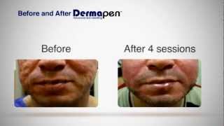 MicroNeedling Before and After  Dermapen® Treatment [upl. by Millisent]