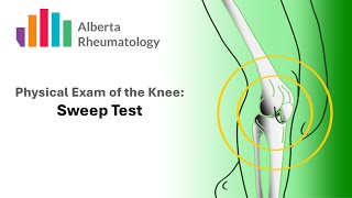 Rheumatology KNEE exam Sweep Test for Joint Swelling or Effusion [upl. by Clark527]