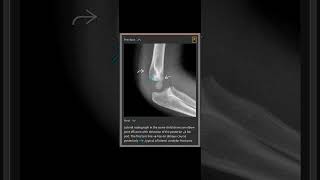 Lateral Condylar Fracture [upl. by Etnoved160]