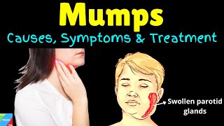 Mumps Symptoms Causes Treatments and Complications [upl. by Lettie]