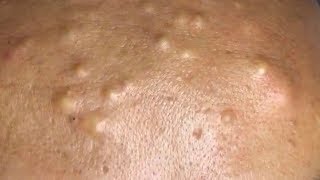 How To Remove Blackheads And Whiteheads On Face Easy 122 ✦ Dr Laelia ✦ [upl. by Eiboh]