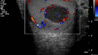 Ultrasound clues that indicate testicular lymphoma [upl. by Peper208]