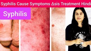 Syphilis Types Sign amp symptoms Diagnosis Treatment Hindi  Syphilis Cause Symptoms Treatment Hindi [upl. by Oimetra]