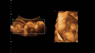 Omphalocele by 4D ultrasound [upl. by Alaham]