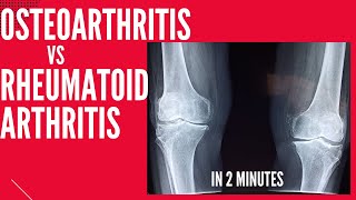 Osteoarthritis vs Rheumatoid arthritis in 2 mins [upl. by Hollister]