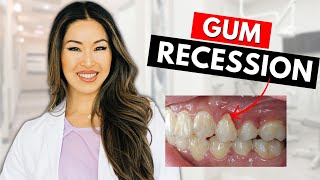 How to Treat and Reverse Gum Recession [upl. by Cammie72]