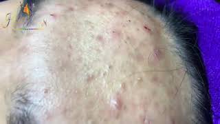 Hien Nguyen Acne 112 Relaxing Blackheads Removal [upl. by Sices549]