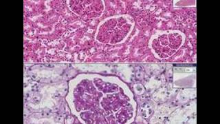 Histopathology KidneyMembranous glomerulonephritis [upl. by Asel]