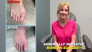 Minimally Invasive Bunion Surgery Patient Testimonials [upl. by Anselma]