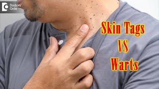 What Causes Skin Tags And Warts  Get Rid of Warts amp Skin Tags Dr Renuka Shetty  Doctors Circle [upl. by Hacissej173]