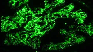 Nephritic syndrome and post infectious glomerulonephritis  Pathology mini tutorial [upl. by Aninat]