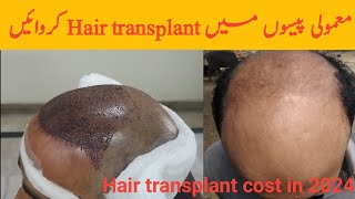 Hair transplant cost in 2024  new bal lagwana ka kharcha 2024 [upl. by Trebloc223]