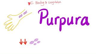 Pupura  Bleeding Disorders [upl. by Berton419]