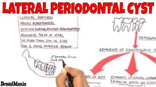 Lateral periodontal cyst  Pathogenesis Clinical Radiographic and Histopathologic features [upl. by Neelehtak]