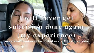 SUBCISION FOR PITTED ACNE SCARS MY EXPERIENCE I WILL NEVER DO IT AGAIN icepickrolling amp box scars [upl. by Nueoht779]