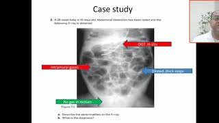 Case 83 necrotising enterocolitis NEC Bell criteria pneumatosis intestinalis pneumoperitoneum [upl. by Amimej]