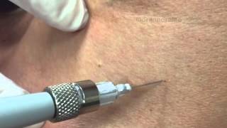 Treating angiomas amp DPNs on the chest with electrocautery For medical education NSFE [upl. by Evans898]