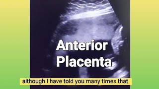 Anterior placenta baby gender  12 weeks Twin pregnancy  3 vessel cord or turtle sign  ultrasound [upl. by Eahcim]