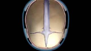 Sagittal Synostosis Helmet Therapy  Craniosynostosis Surgery [upl. by Tomlin]