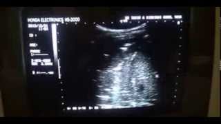 PYOTHORAX RT another case [upl. by Gottwald]