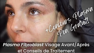 Plasma Fibroblast Visage AvantAprès  Giveaway  Je Vous dis Tout [upl. by Naitsirhc906]