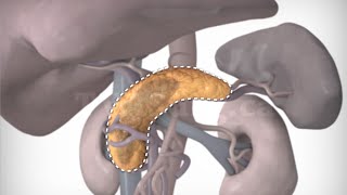 Total pancreatectomy [upl. by Allyn]