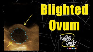 Blighted Ovum  Ultrasound  Case 147 [upl. by Egidio]