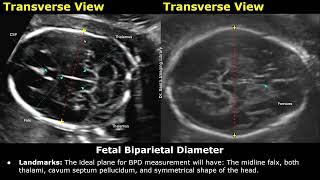 How To Measure Fetal Biparietal Diameter On Ultrasound  BPD Measurements  Biometric Parameters USG [upl. by Potts444]