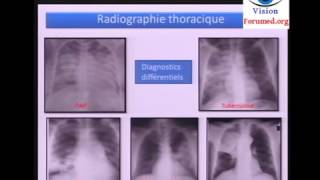 Cas Clinique sur la Pneumonie  Deuxième Partie Cours de Médecine [upl. by Hsenid]