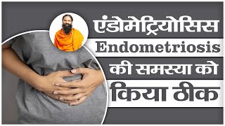 एंडोमेट्रियोसिस Endometriosis की समस्या को किया ठीक  Swami Ramdev [upl. by Afnin]