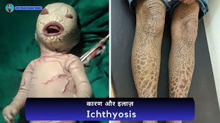 मछली जैसे चमड़ी का कारण  Fish like skin reason  cracked skin  Ichthyosis  Dr Uttam Lenka [upl. by Nyleda]