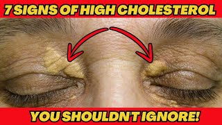 7 Signs of High Cholesterol You Shouldnt Ignore [upl. by Reffotsirhc]