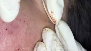 Big Cystic Acne Blackheads Extraction Blackheads amp Milia Whiteheads Removal Pimple Popping [upl. by Dniren]